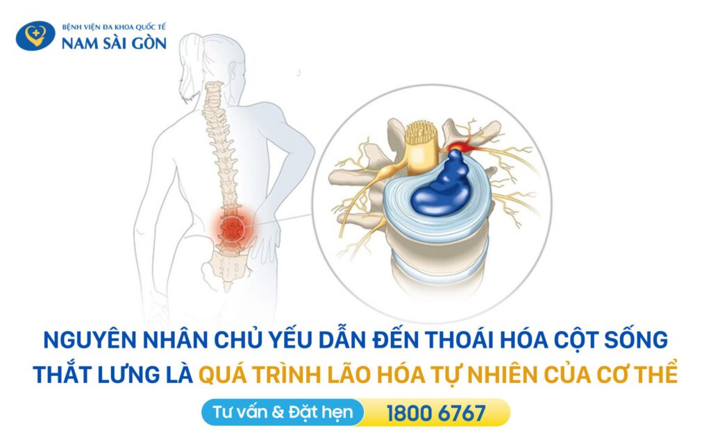 nguyên nhân thoái hoá đốt sống thắt lưng