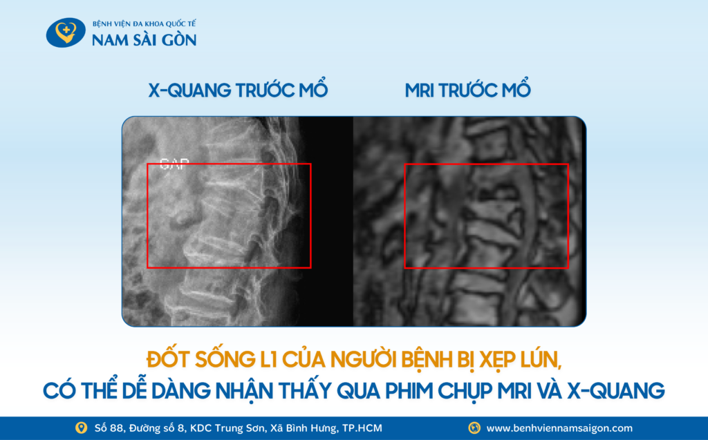 Đốt sống L1 của ông T. bị xẹp lún và tình trạng gù lưng có thể dễ dàng nhận thấy qua phim chụp MRI và X-quang.
