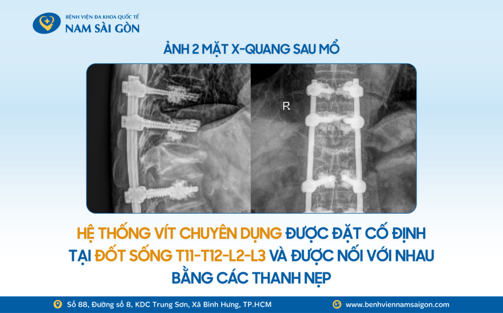 2026 03 06 Website H4 THOAT CANH NGOI XE LAN SAU 3 NGAY PHAU THUAT COT SONG