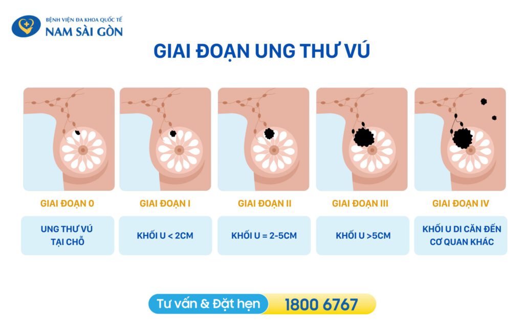 ung thư vú có mấy giai đoạn