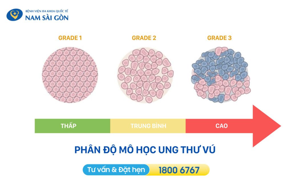 các giai đoạn ung thư vú