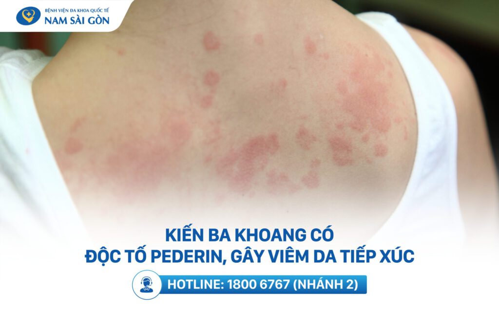hình ánh bị kiến ba khoang cắn