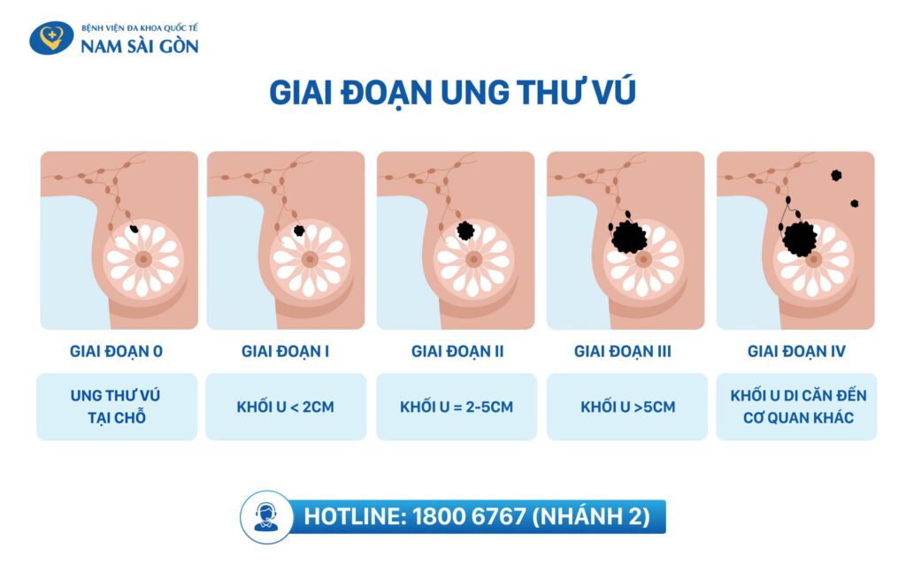 Các giai đoạn ung thư vú 