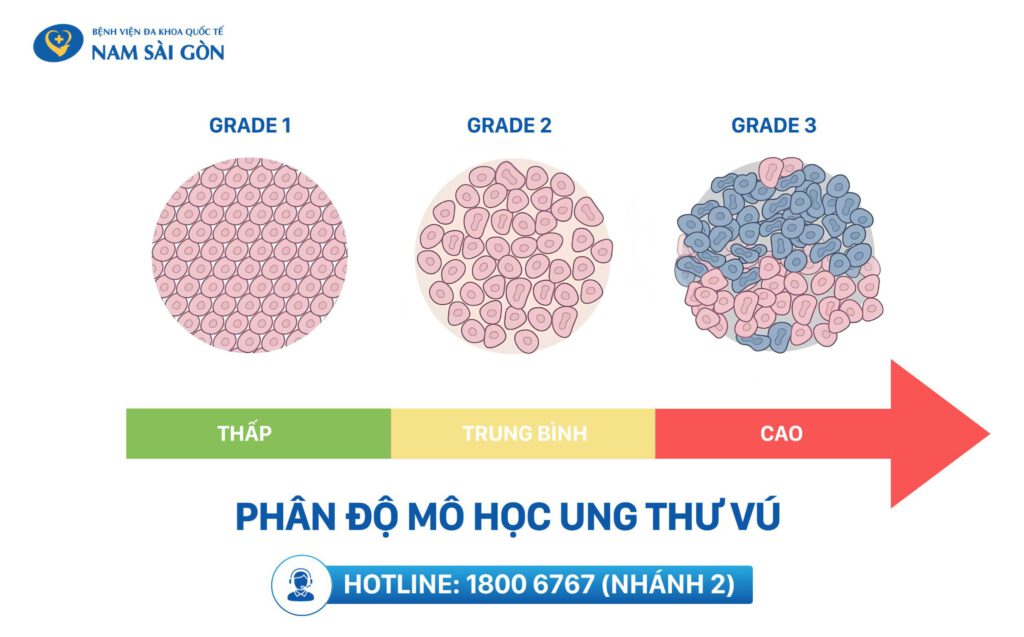 Hệ thống phân loại u vú TNM