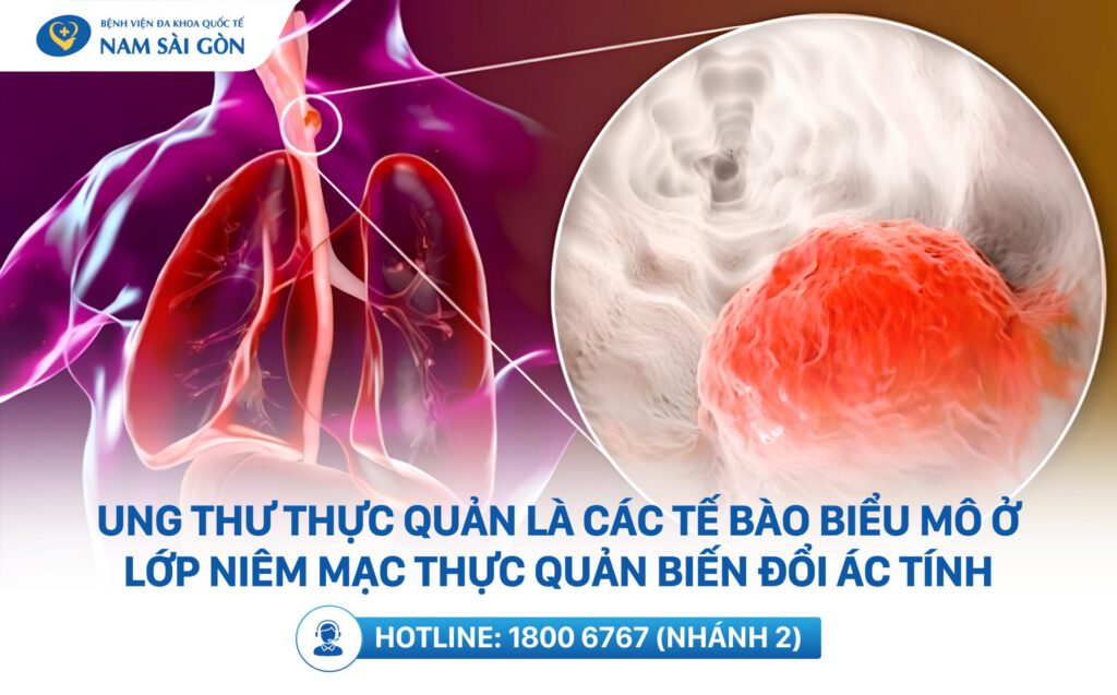 ung-thu-thuc-quan-la-gi