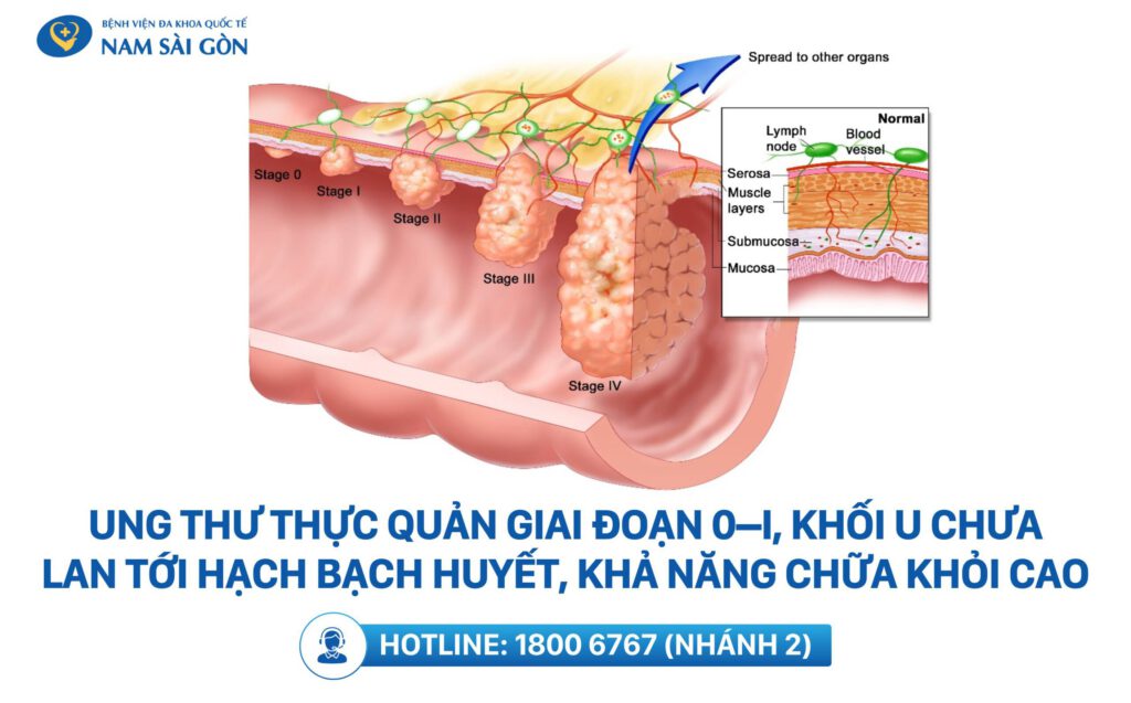 giai-doan-ung-thu-thuc-quan