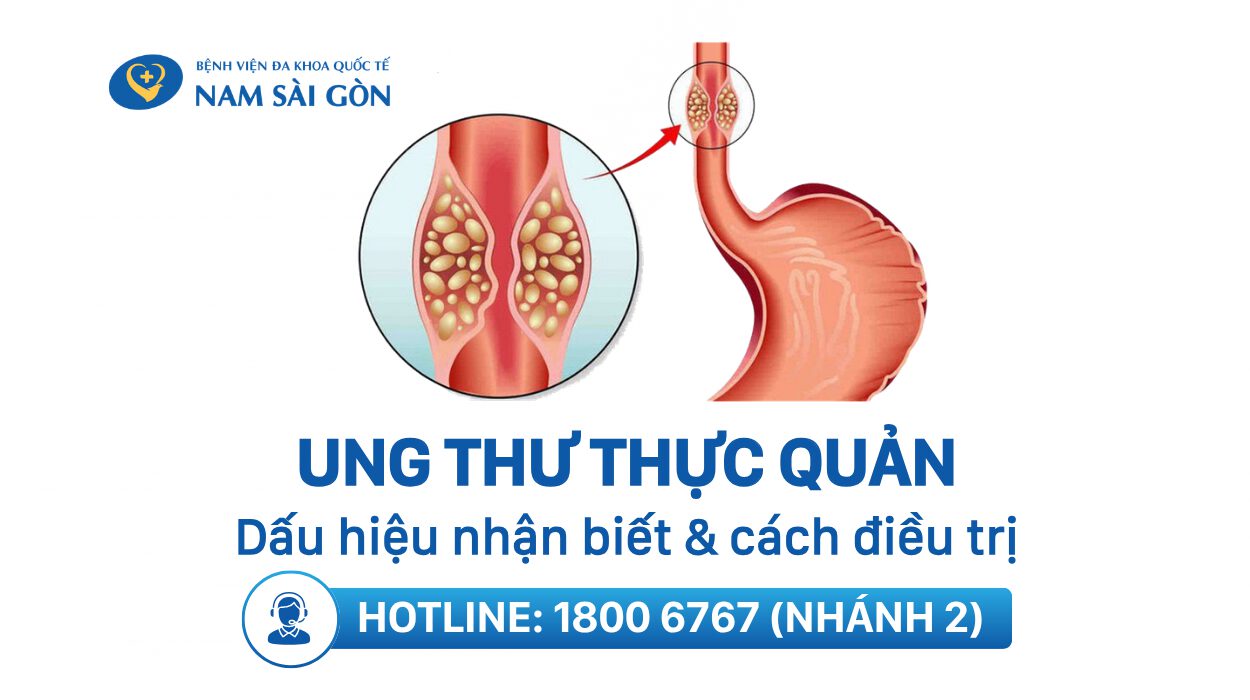 UNG THƯ THỰC QUẢN – DẤU HIỆU NHẬN BIẾT VÀ CÁCH ĐIỀU TRỊ HIỆU QUẢ NHẤT