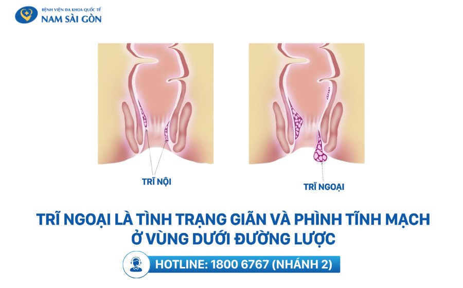 trĩ ngoại là bệnh gì