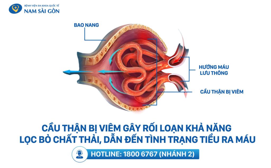 viêm cầu thận là gì