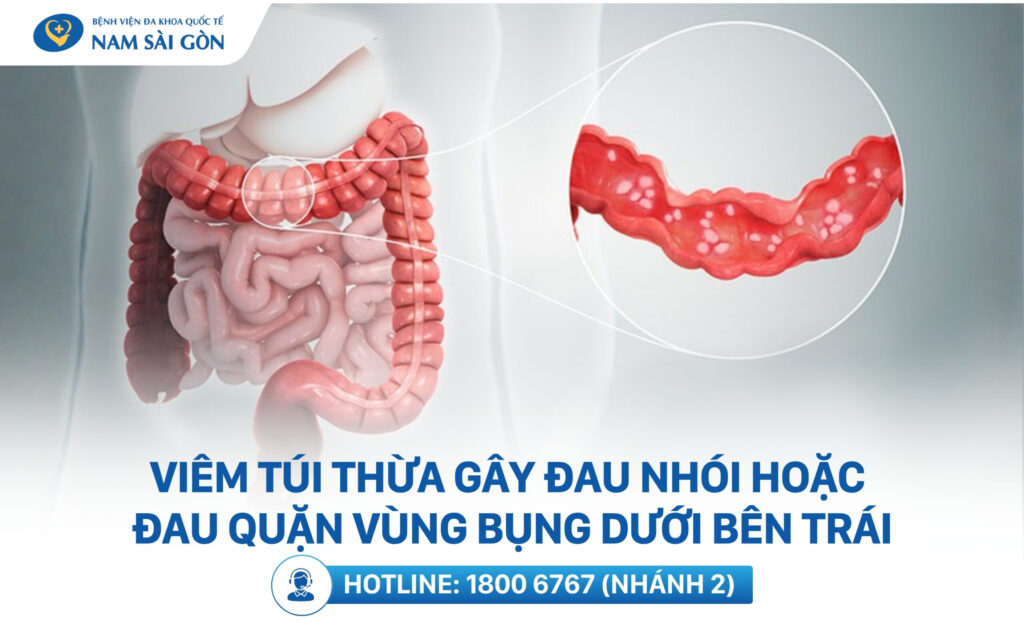 đau bụng bên trái ngang rốn