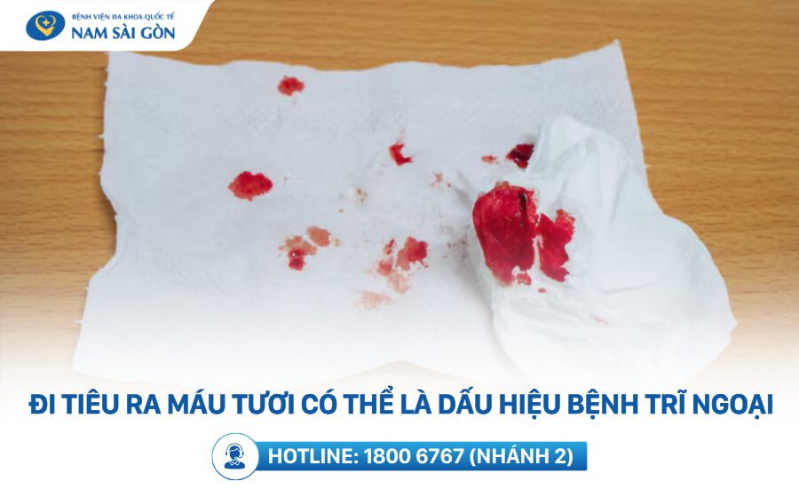 dấu hiệu bệnh trĩ ngoại
