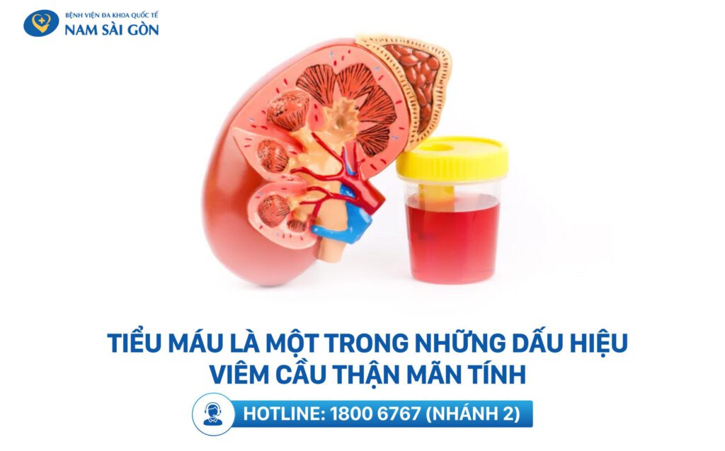 triệu chứng viêm cầu thận
