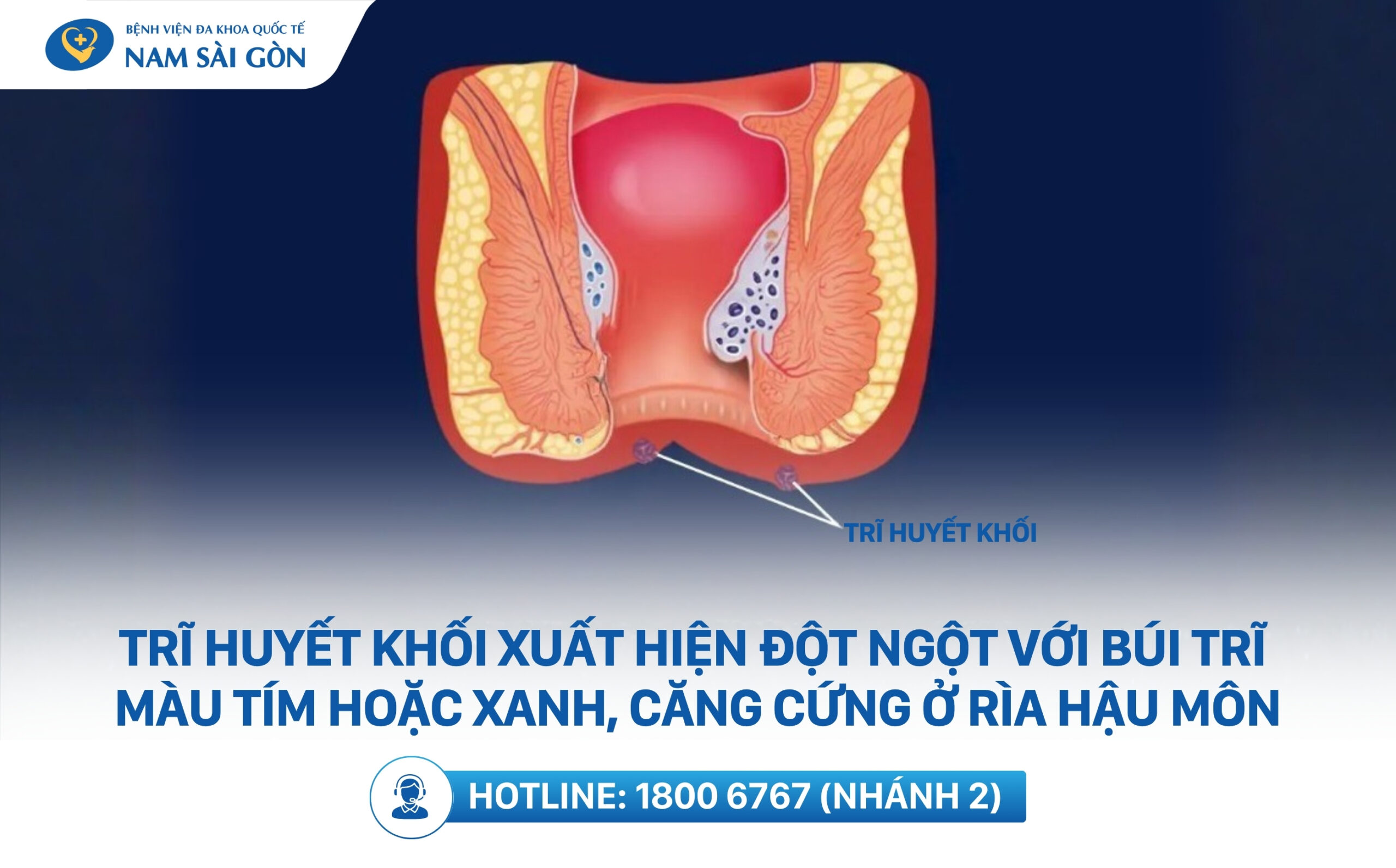 trĩ huyết khối là gì