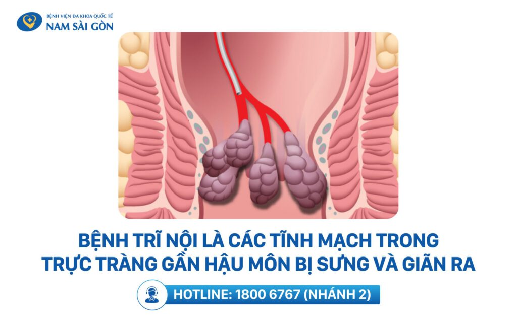 trĩ nội là gì