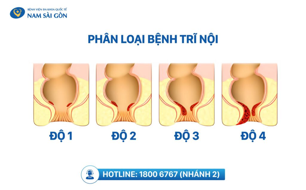 bệnh trĩ nội