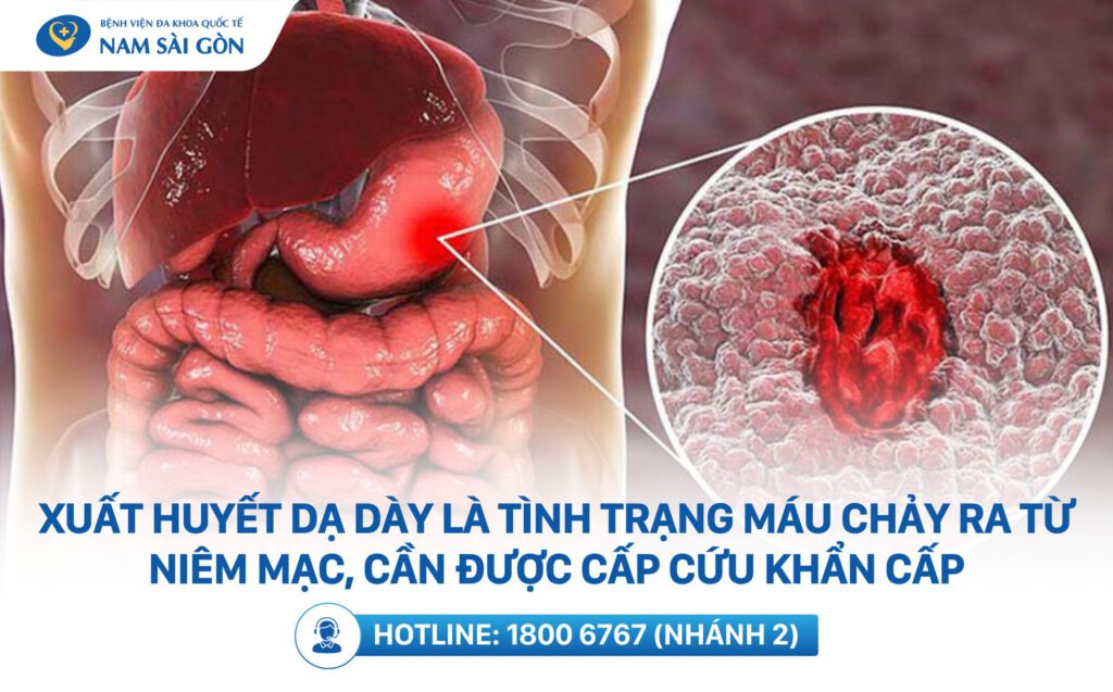 Xuất huyết dạ dày là gì