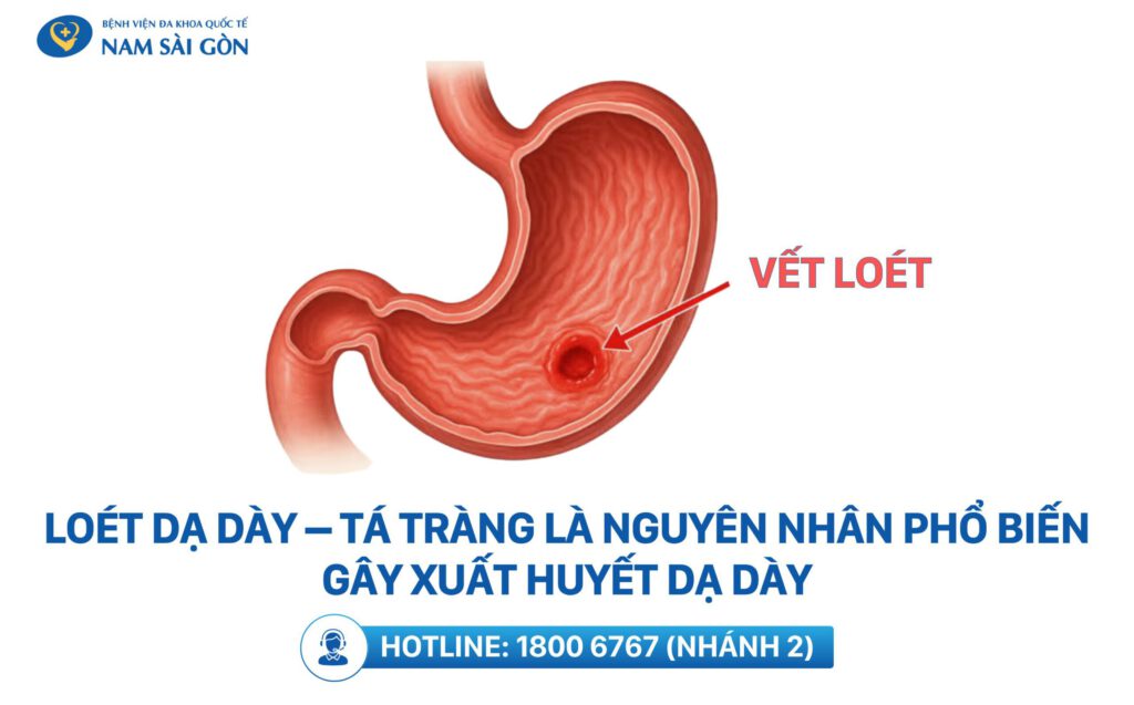 nguyên nhân xuất huyết dạ dày