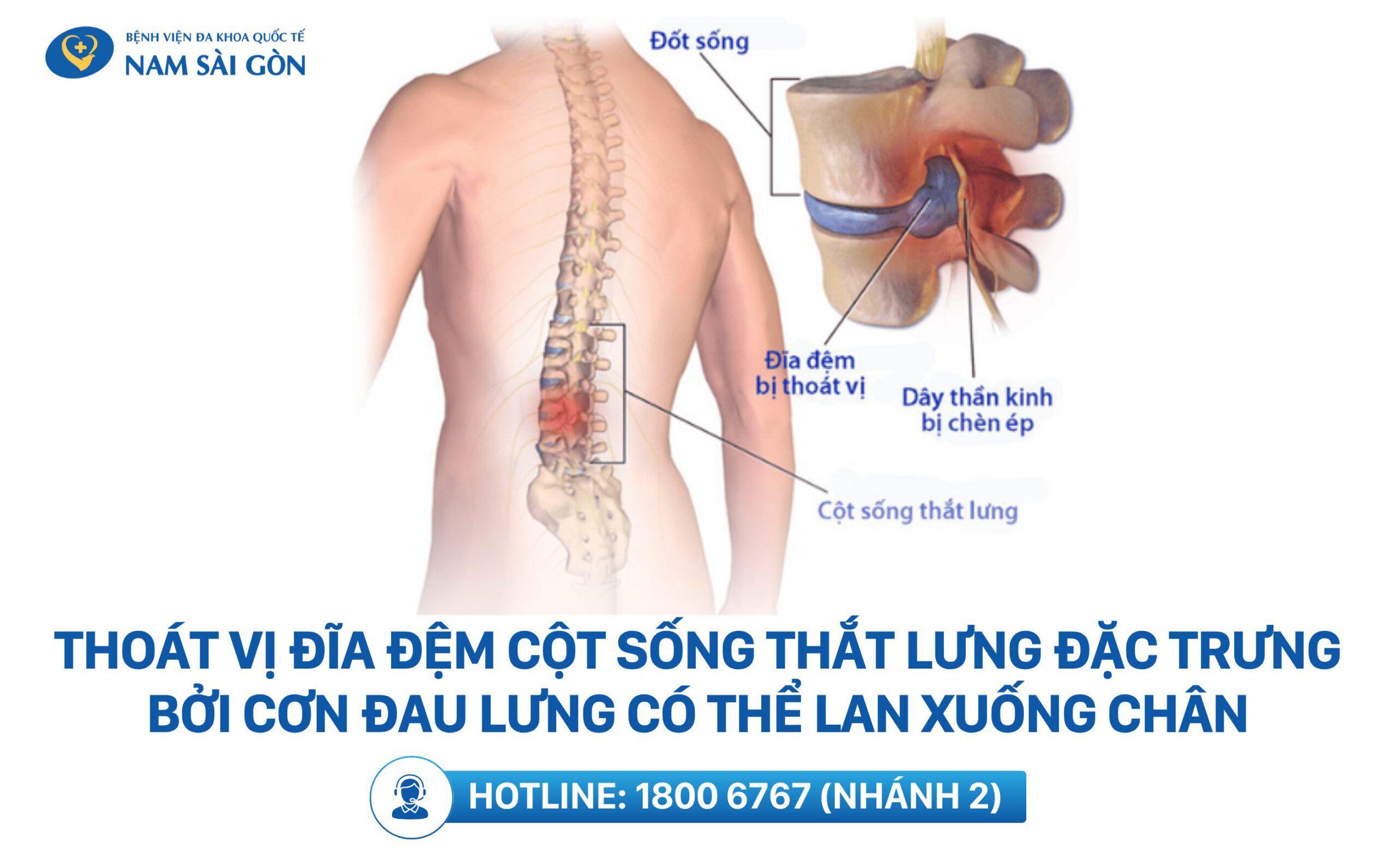 dấu hiệu đau lưng