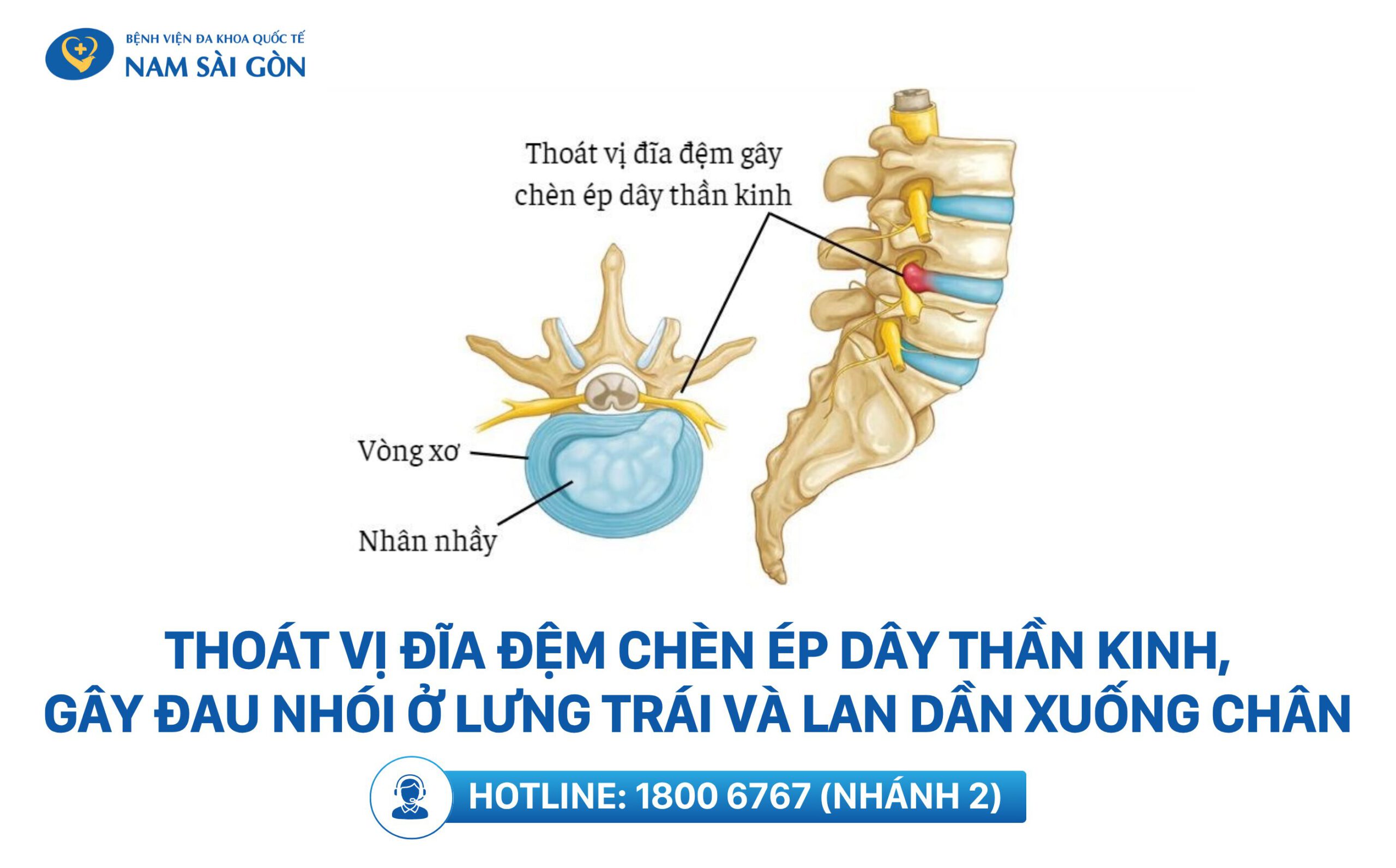 bị đau bên hông trái sau lưng