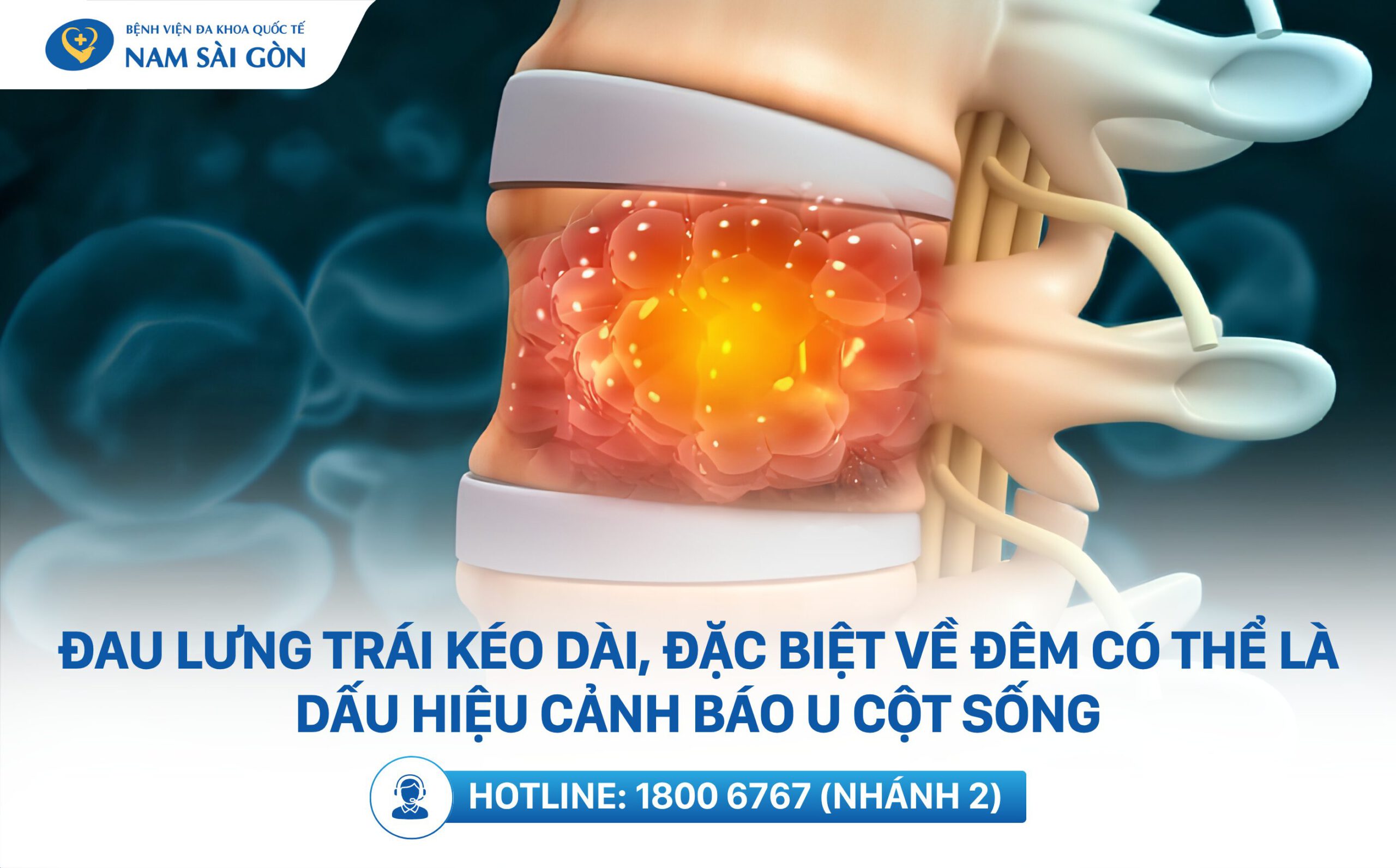 đau lưng dưới bên trái
