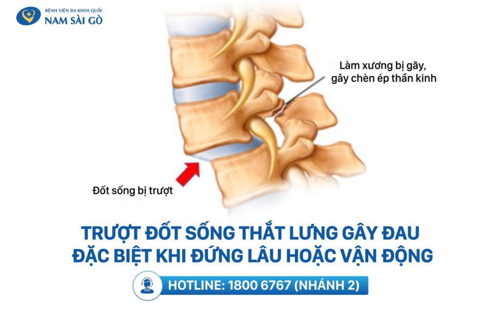 đau lưng không cúi được