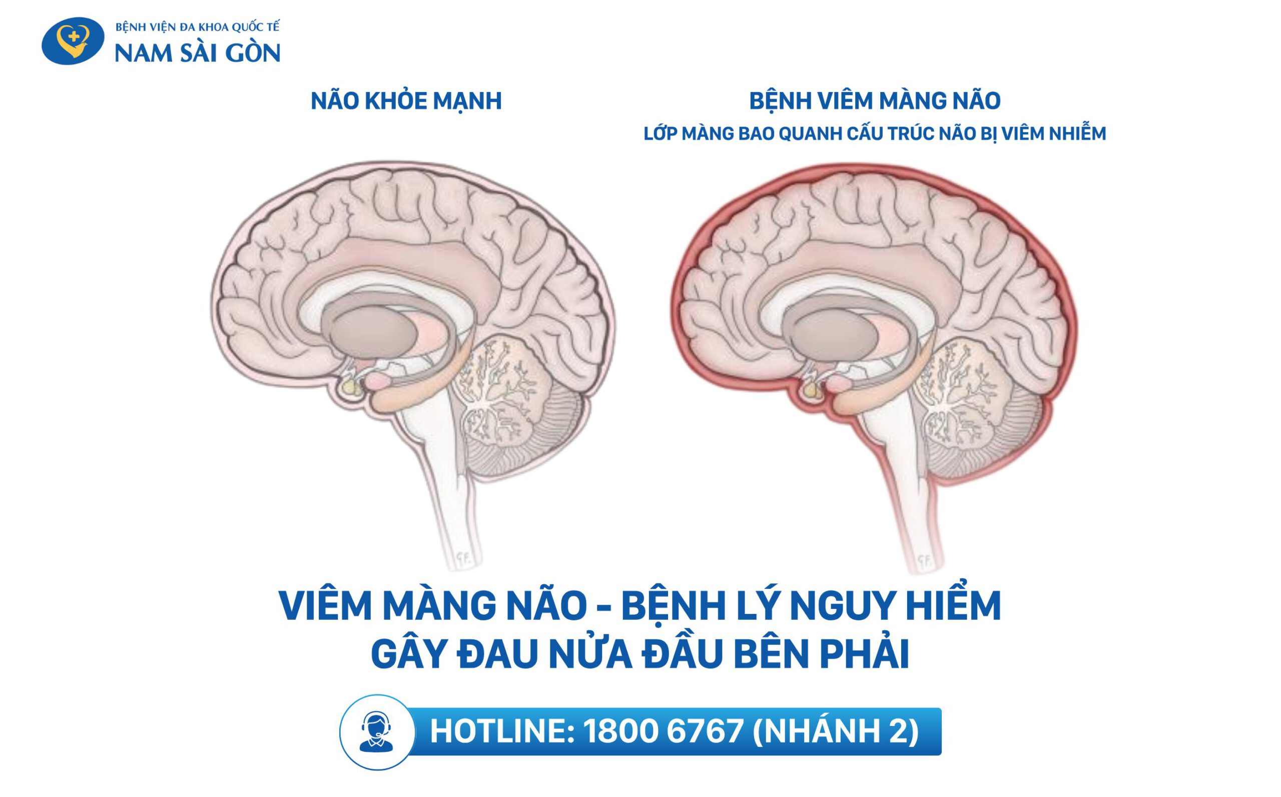bệnh gây đau nửa đầu bên phải