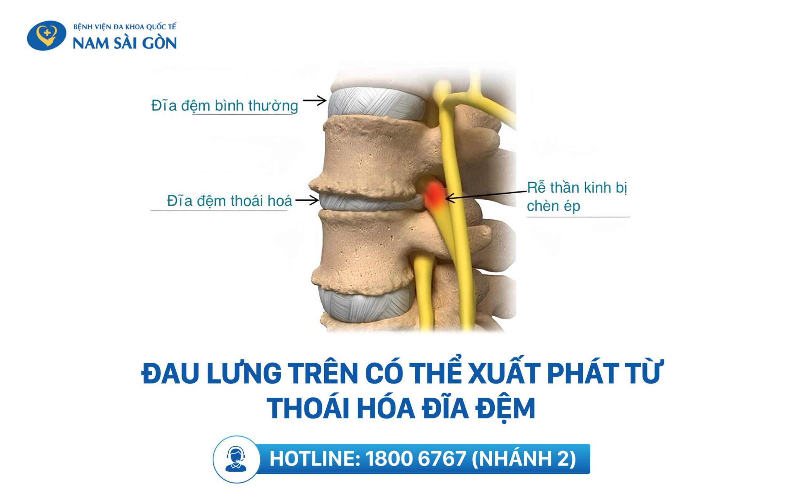 mỏi lưng trên