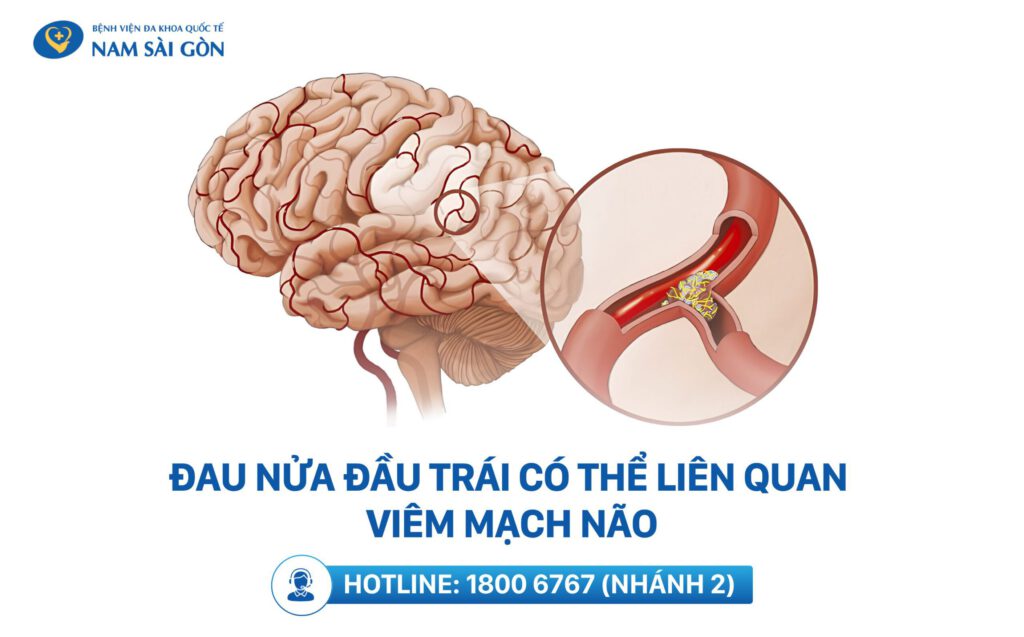 nguyên nhân đau nửa đầu bên trái