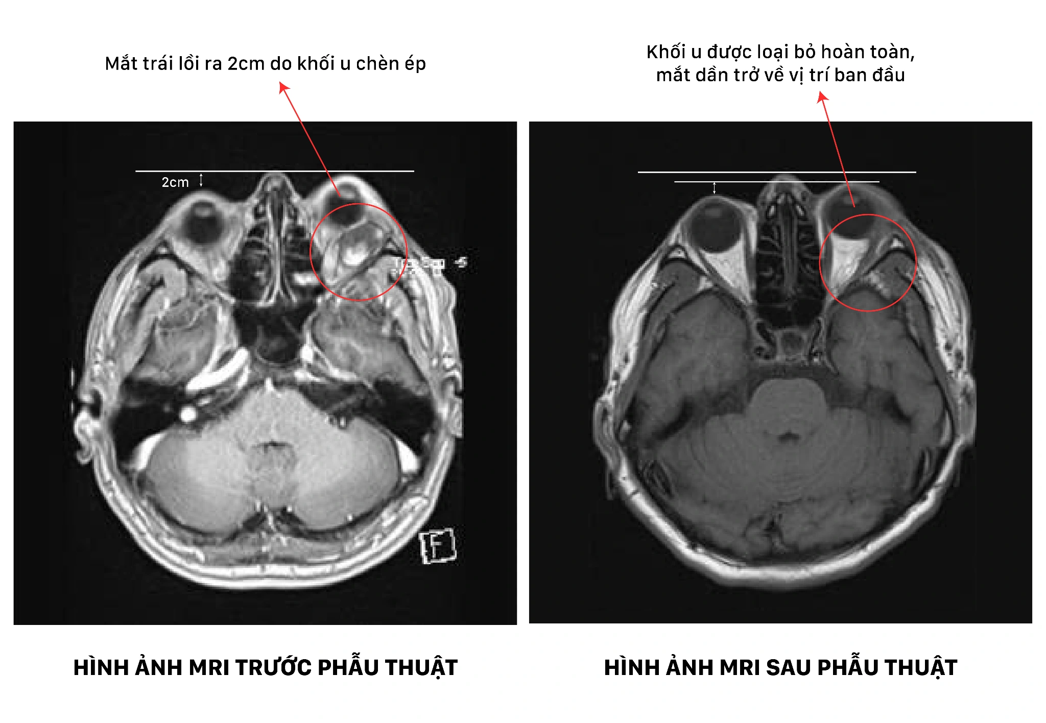 4 giờ nghẹt thở dưới kính vi phẫu giải cứu đôi mắt bị khối u chèn ép