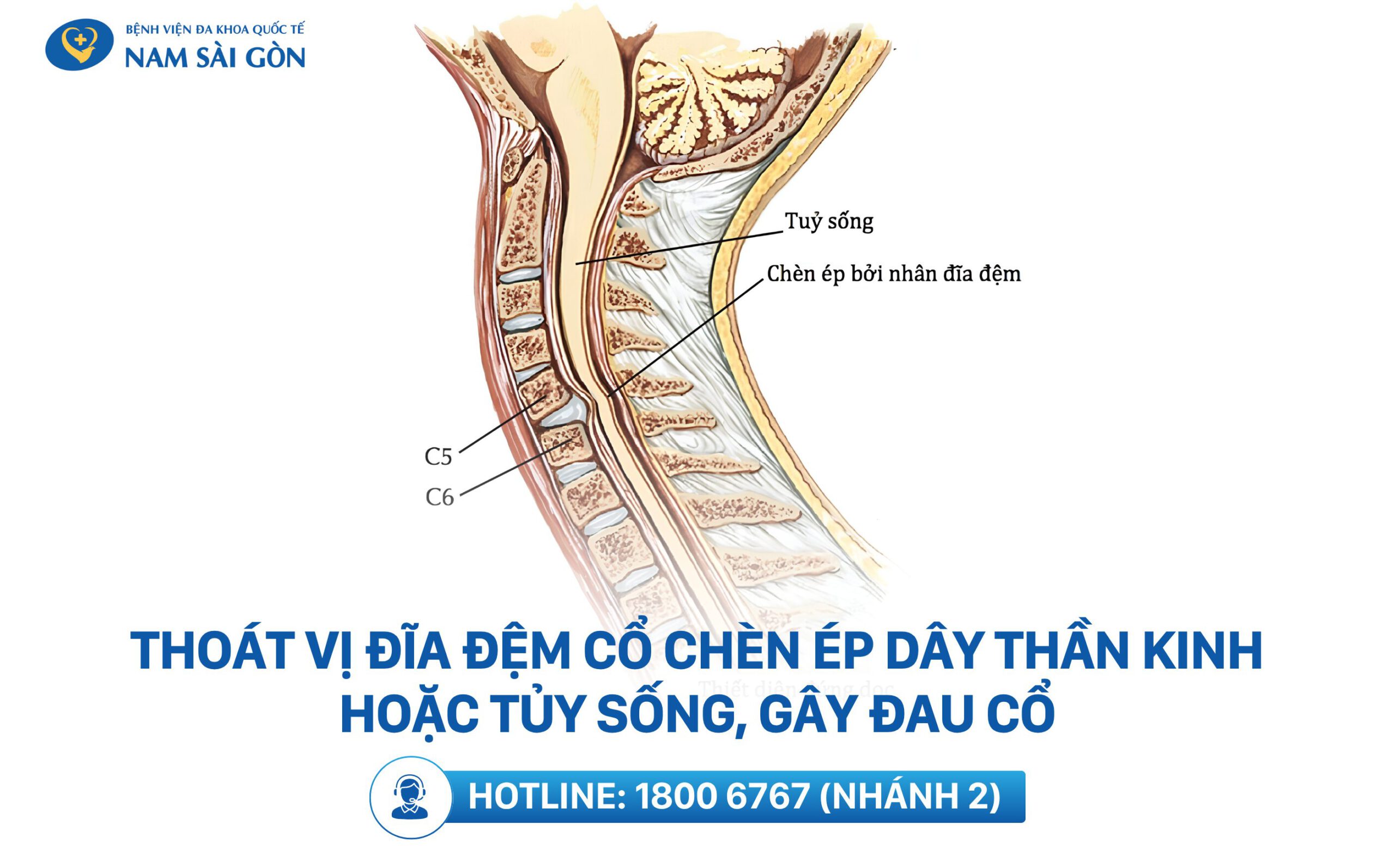 đau cơ cổ bên trái