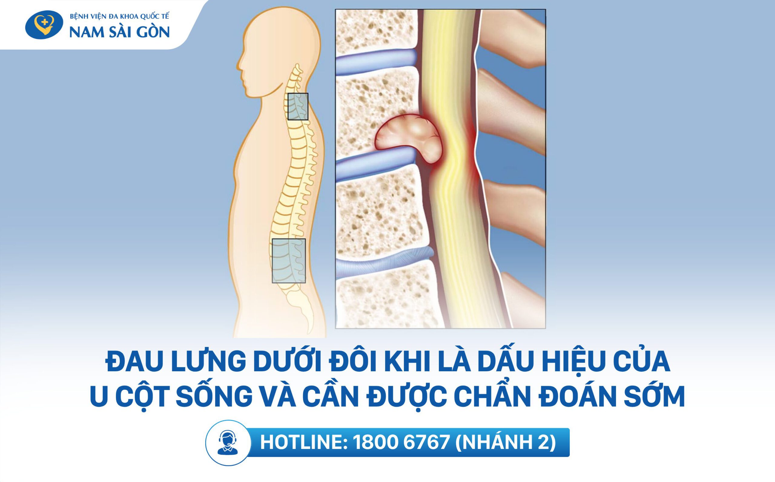 mỏi lưng dưới