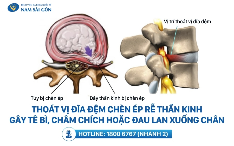 thoat-vi-dia-dem-chen-ep-re-than-kinh