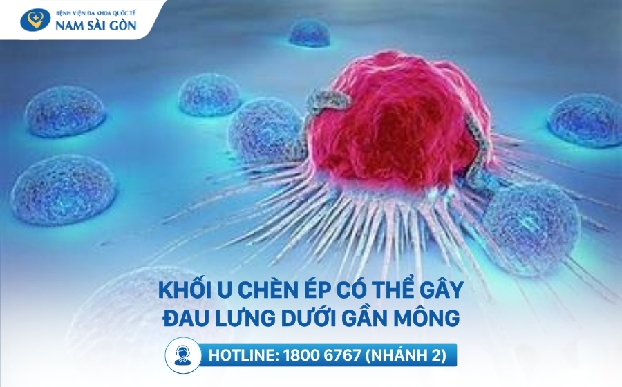 khoi-u-chen-ep-co-the-gay-dau-lung-duoi-gan-mong